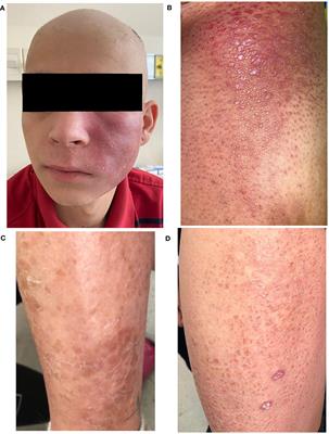 Case Report: Mycosis fungoides as an exclusive manifestation of common variable immunodeficiency in a family with a NFKB2 gene mutation